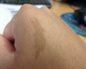 Hindi-home-remedies-to-remove-birth-marks