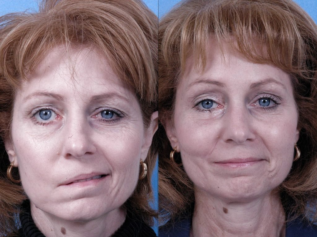 palsy paralysis benumb paralyse paralyze lakawa lakava nervous system spinalcord stroke nerve injury cerebral palsy disease yoga asana yogasana pranayama ayurveda neuropathy parkinsons