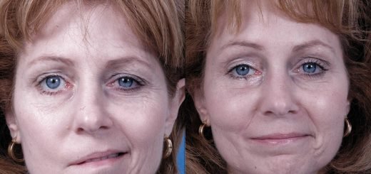 palsy paralysis benumb paralyse paralyze lakawa lakava nervous system spinalcord stroke nerve injury cerebral palsy disease yoga asana yogasana pranayama ayurveda neuropathy parkinsons